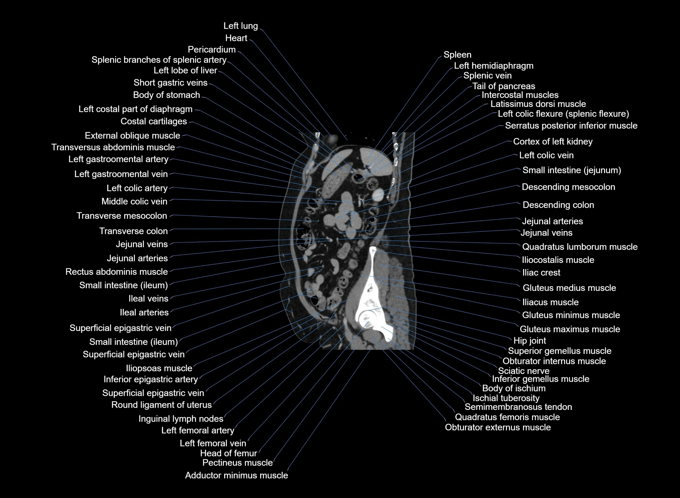 CT Abdomen sagittal cross sectional anatomy labelled radiology image -00032.webp